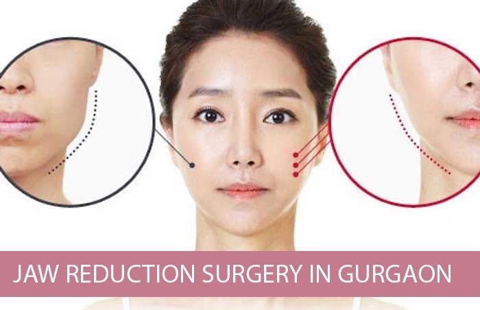 Jaw Reduction Surgery In Gurgaon Delhi NCR Jaw Reduction Surgery jaw-reduction-surgery-in-gurgaon-delhi-ncr-jaw-reduction-surgery