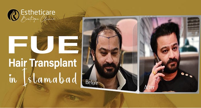 Discover the Revolutionary FUE Hair Transplant in Islamabad