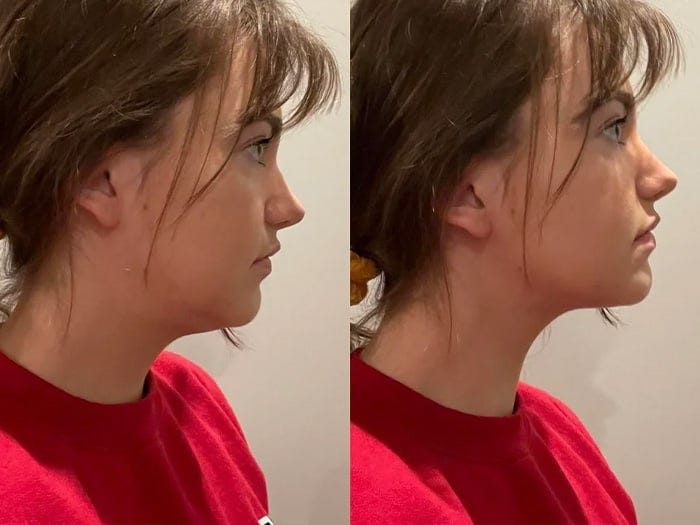 Mewing Myth: Can It Reshape Your Jawline?