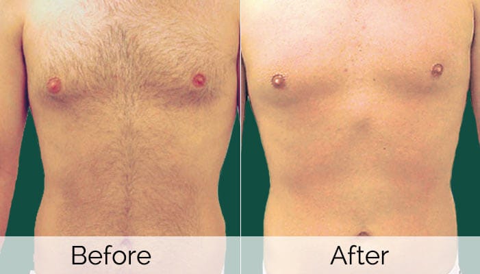 Painless Laser Body Hair Reduction (Removal) by Studio Aesthetique