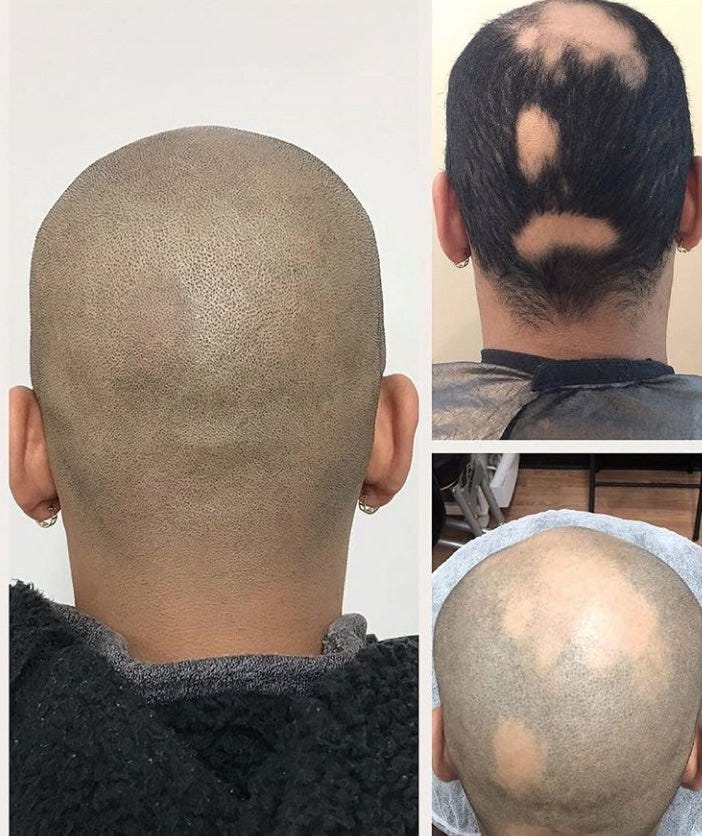 How Can Scalp Micropigmentation Help Treat Alopecia? by Precise