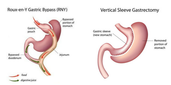 Reflux After Sleeve Gastrectomy - Bariatric Surgery