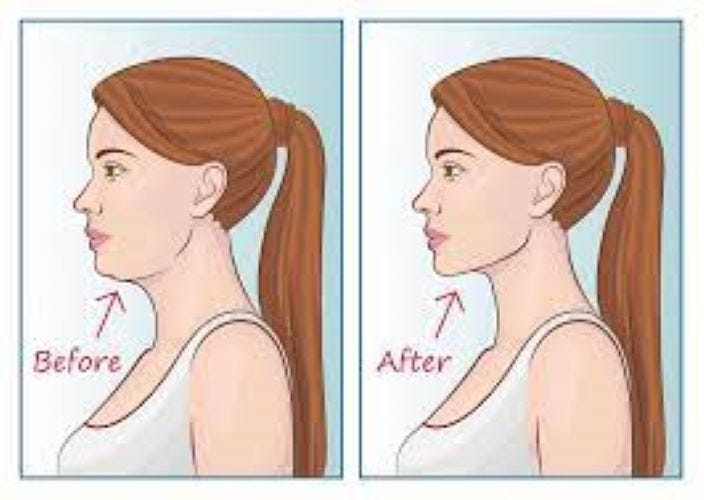 mewing before after result  Jawline exercise, Face, Facial