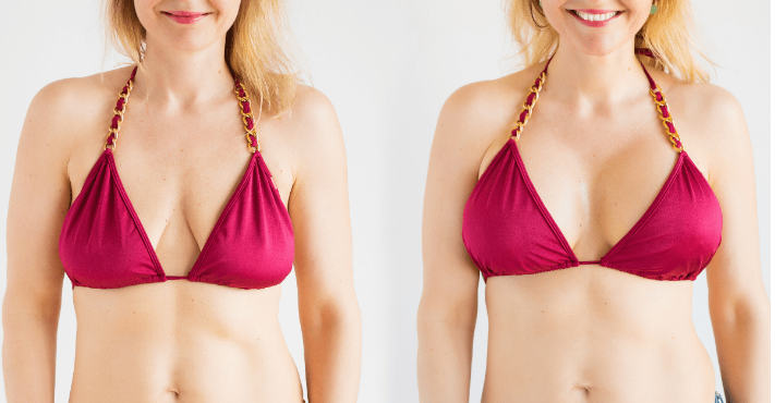 Get Your Breasts Moderately Increased or Decreased with Fat Grafting, by  Dr. Daniel Barrett