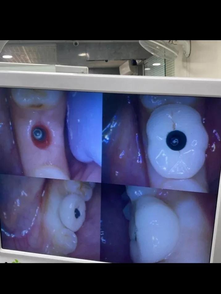 Expert Root Canal Treatment Services in Pune Pathak Dental Clinic