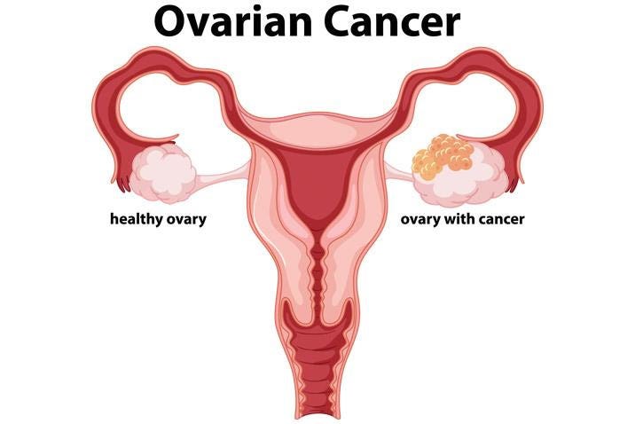 ovarian-cancer-blood-test-illustration-stock-photo-alamy