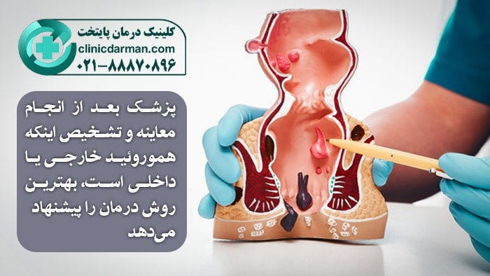 لیزر بواسیر