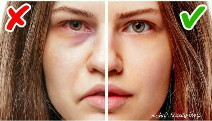 15 reasons you have puffy eyes in the morning!