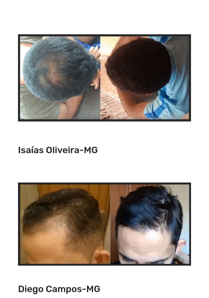 Calvície feminino e Calvície masculina, revolucionário tratamento para calvície de forma natural.
