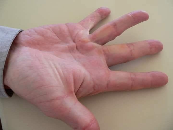illustration of the hand of a person with Dupuytren’s diseas (Frank C. Müller, Wikimedia Commons, CC BY-SA 4.0)