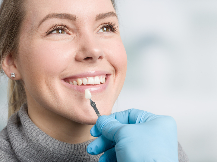 Are Veneers Permanent? Exploring the Lifespan of Veneer Teeth by