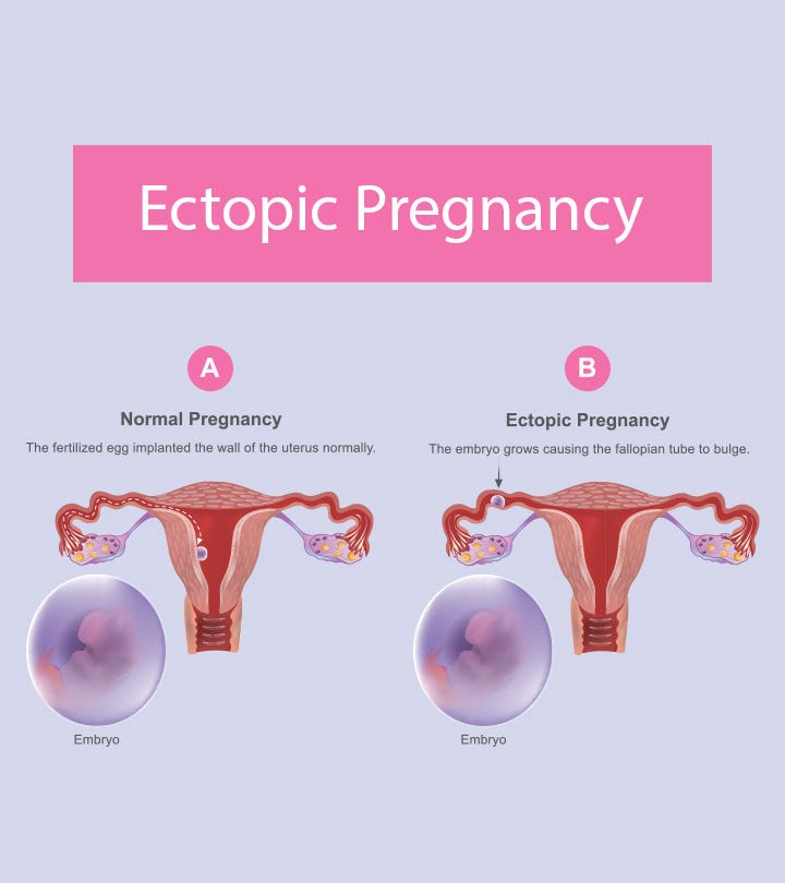 What is the recovery process after ectopic pregnancy treatment
