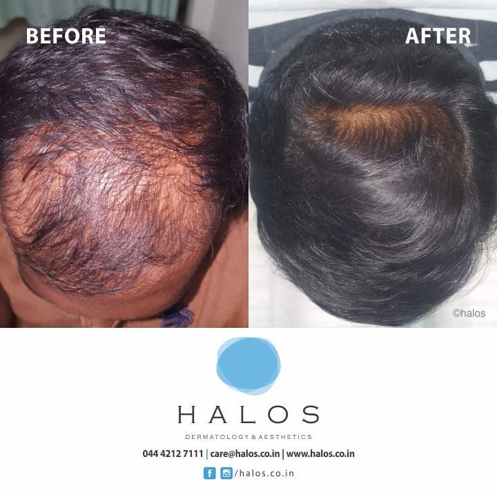 Best Prp Treatment For Hair Loss Hair Fall Treatment In Chennai Best Prp Treatment For Hair Loss Hair Fall Treatment In Chennai