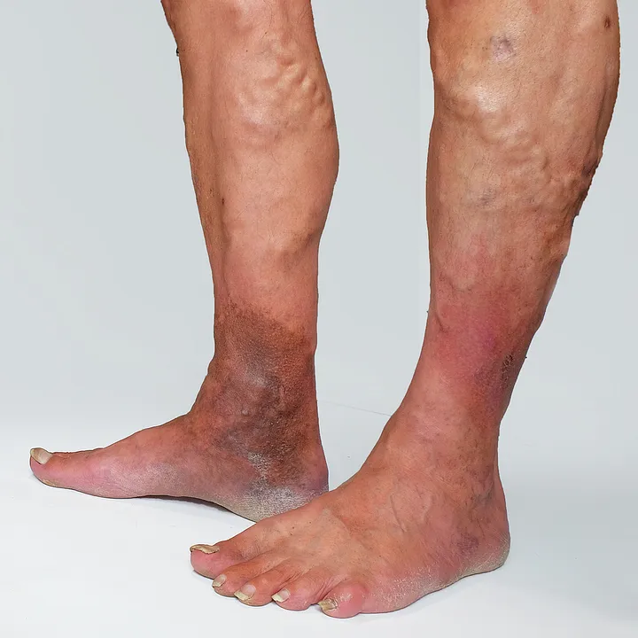 varicose eczema symptoms