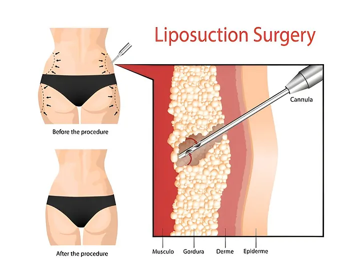 How Liposuction Works