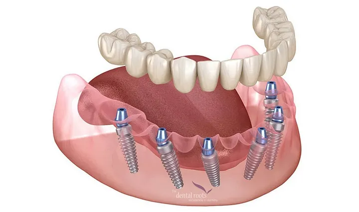 all-on-6-dental-implants-in-india