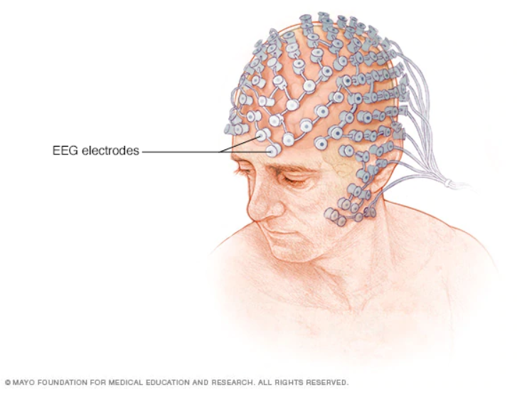 What is an EEG (electroencephalogram)? A layman’s explanation from a ...