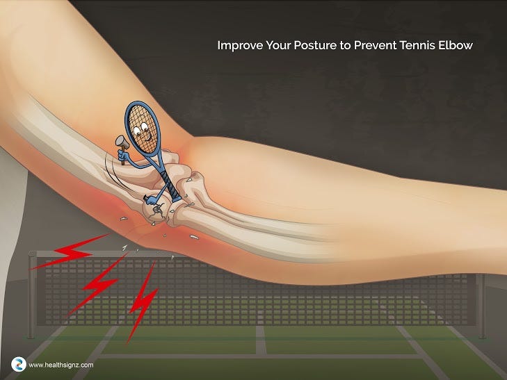 Tennis Elbow: Causes, Symptoms, Prevention & Treatment | by HealthSignz |  Medium