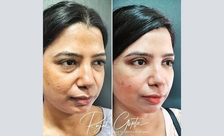 What is Single Eyelid or Double Eyelid Surgery?