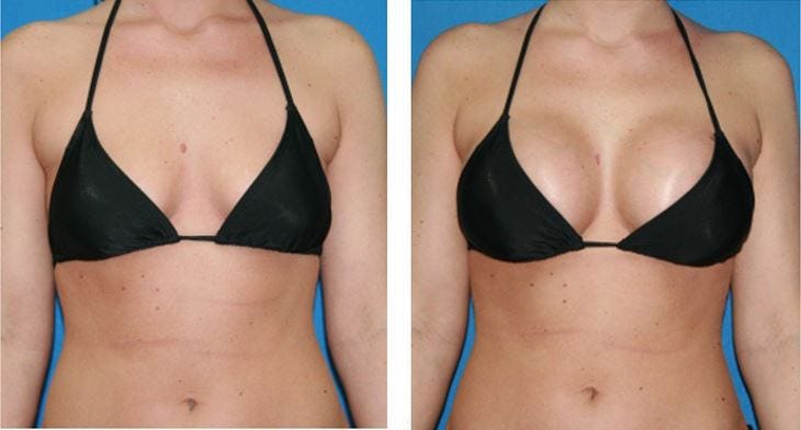 Get Complete Guide for Breast Enhancement
