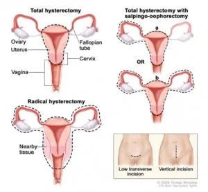 Should Hysterectomy-Oophorectomy be done Before or After Microsurgical Breast Reconstruction?