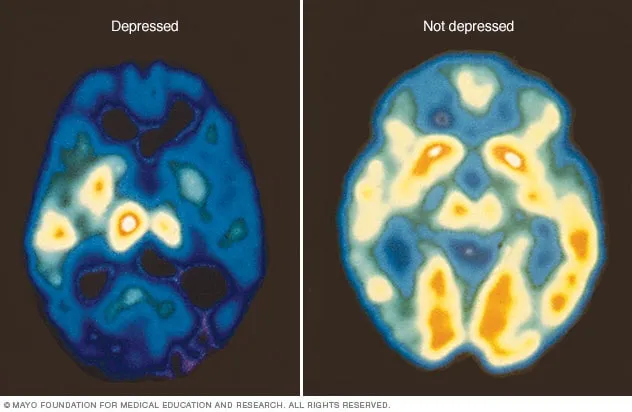 PET scan comparing brains of depressed and not depressed patients