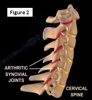 Psoriatic Arthritis