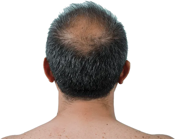 Profollica Hair Loss Treatment Reviews