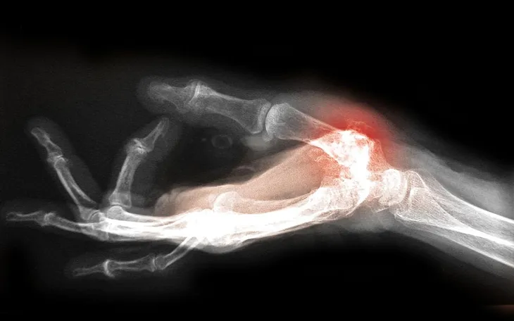 Study Finds Gene Mutation Responsible for Arthritis use to Help Frostbite Survival