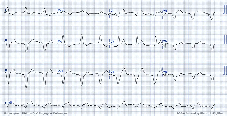 Figure 3.a — ECG — concordant ST elevation in V2, proportionally excessively discordant STE in V3 and concordant ST depression in V6 (Dr.Smith’s ECG Blog, digitized by PMcardio)