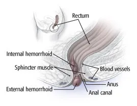 Facts You Ever Wanted to Know About hemorrhoids