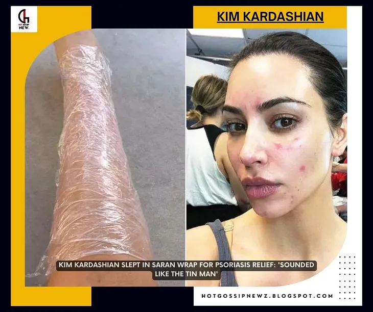 Kim Kardashian reminisced about her battle with psoriasis and some of the unconventional remedies…