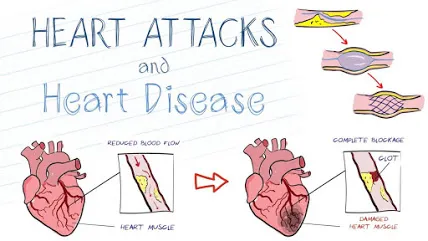 Heart Attack: Symptoms, Causes, Treatment, and Prevention