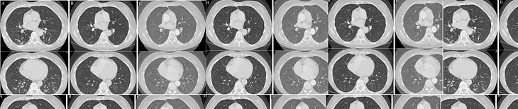 “MLOps for Chest CT Scan Image Classification: A Step-by-Step Guide”