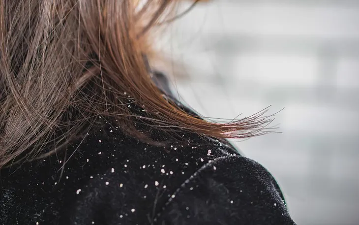 How to Combat Dandruff: Expert Tips from Concord Hair Clinic