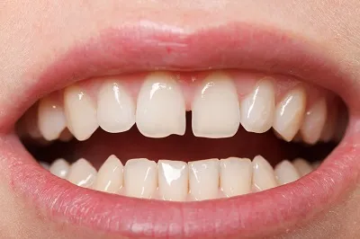 Do Retainers Help To Close Teeth Gaps?