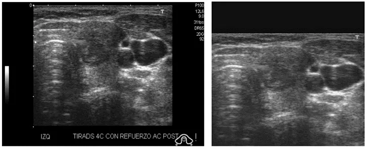 The Basic Classification of Thyroid Tumors on UltraSound Images using Deep Learning Methods