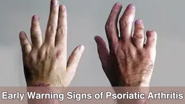 What are the Early Warning Signs of Psoriatic Arthritis?