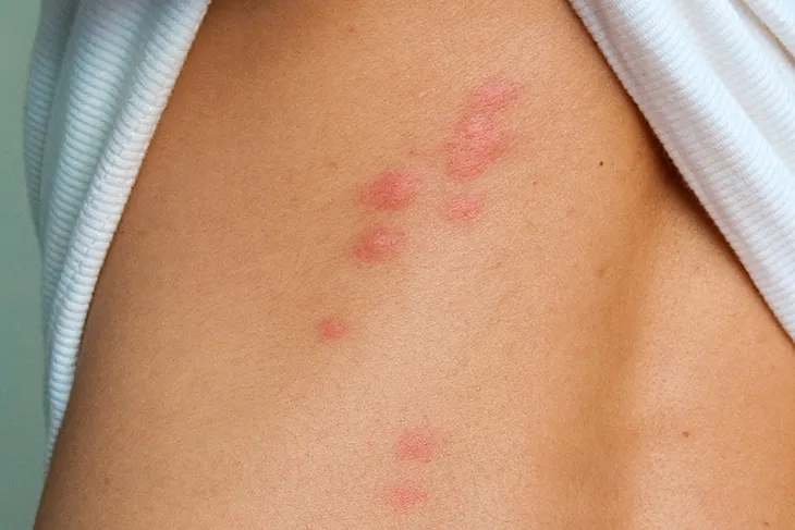 Bed bug bites