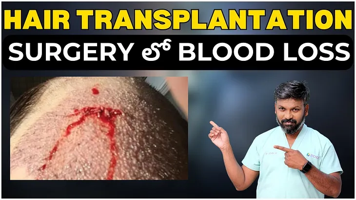 Why do some hair loss patients face bleeding problems during hair transplant procedures?