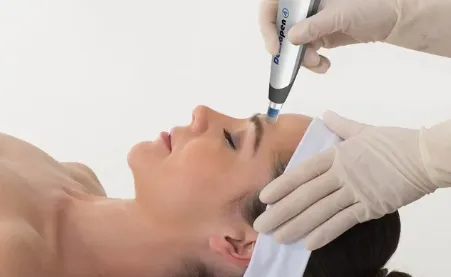 Exion RF Microneedling Treatment in London