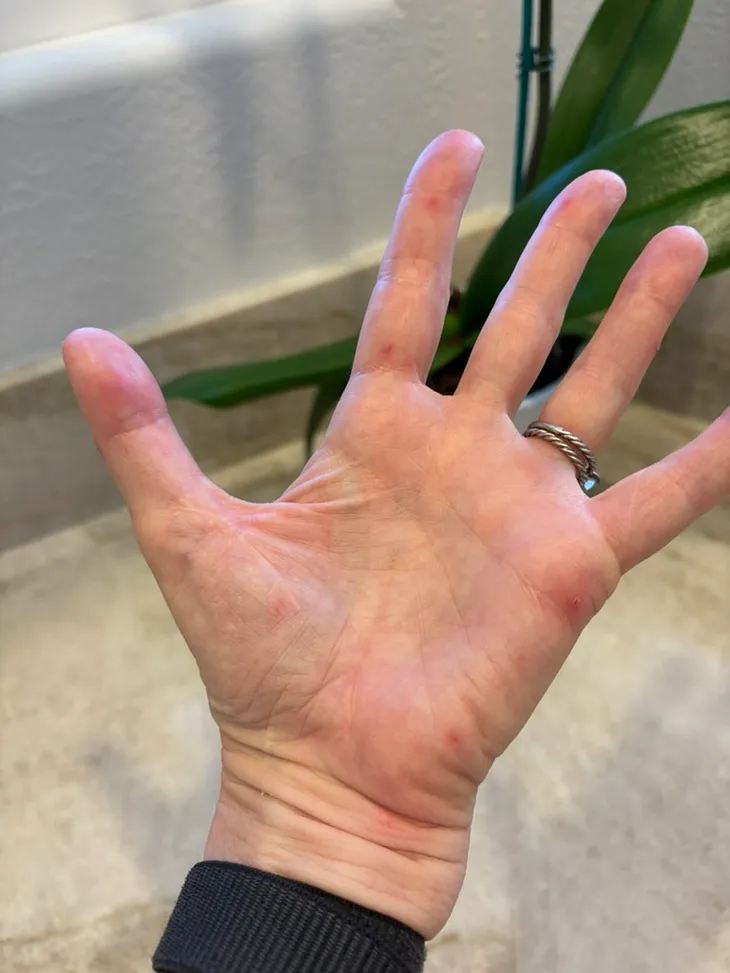 My palmar rash reminiscent of syphilis, scabies and other scourges.