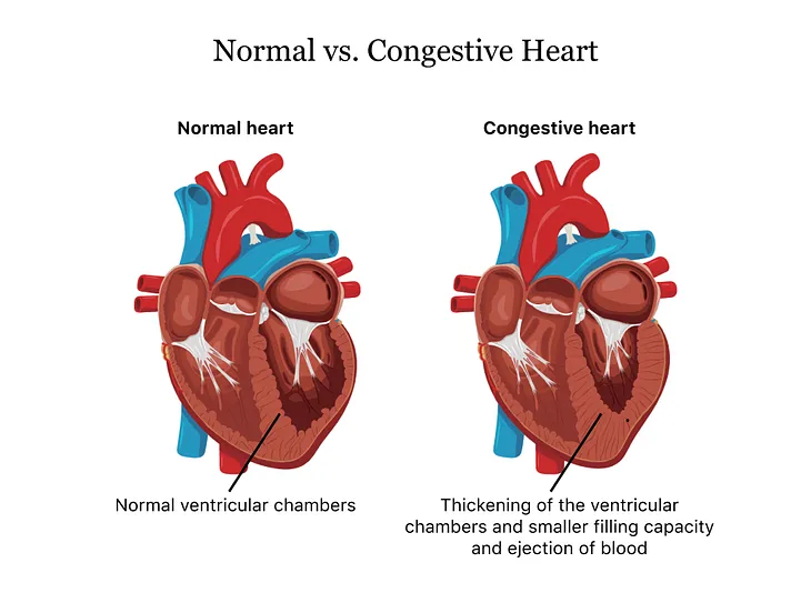 Congestive Heart Failure