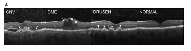 Retinal OCT(optical coherence tomography) Images classification using CNN