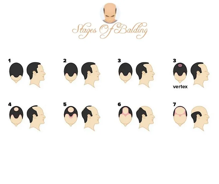 seven stages of balding