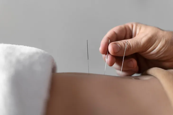 How Long Does Acupuncture Take To Work For Back Pain?