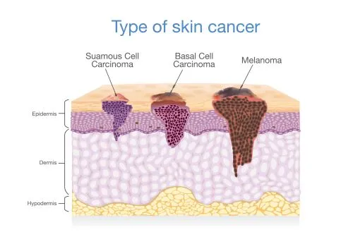 Understanding Skin Cancer: Causes, Types, and Prevention