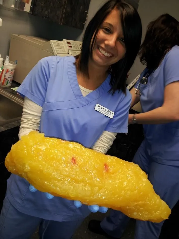 What Does 20 Pounds of Fat Look Like: