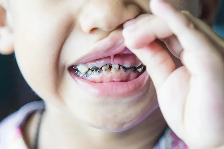 a child with dental caries