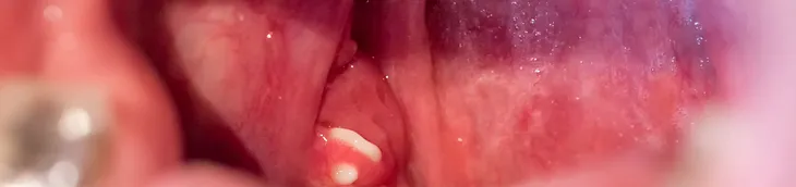 Cryptic Tonsils: Causes, Symptoms and Treatment